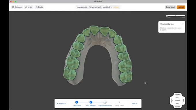 custom aligner treatment plans with 3d clincheck