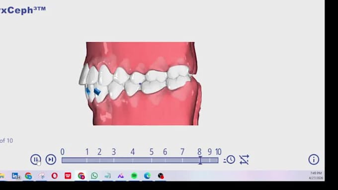 create onyxceph 3d clear aligner treatment plans and aligner setups