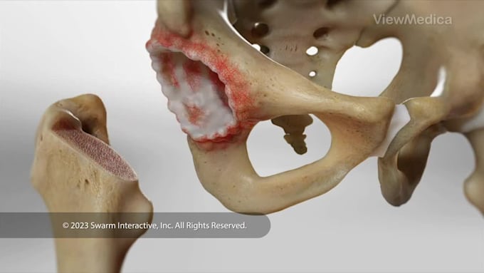 3d medical animation, surgery explainer video, medical device pharmaceutic moa
