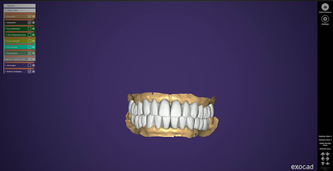 design custom abutments and full arch implant restorations
