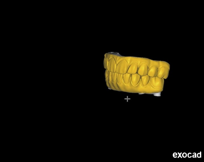 screw retained prosthesis crowns, bridges, full arch