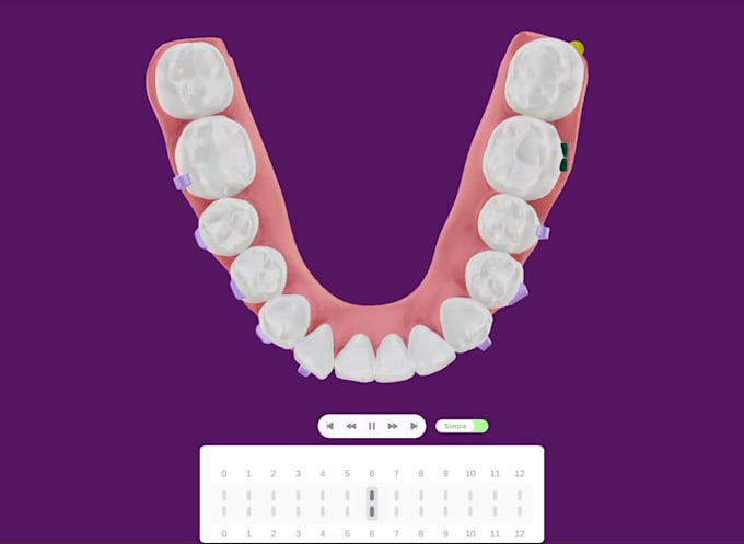 design custom clear aligner treatment plan