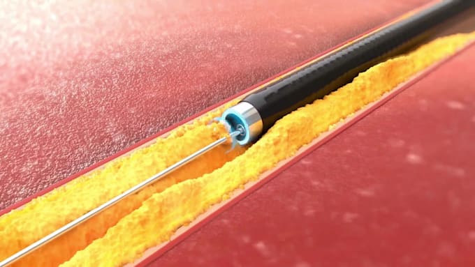 do 3d medical device, catheter, vascular explainer and surgical device animation