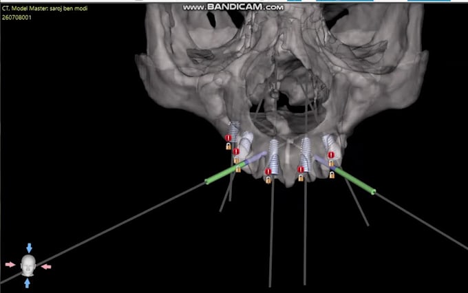 plan and design surgical guide