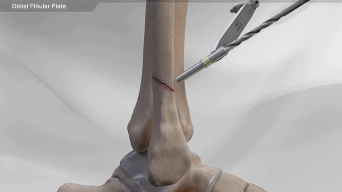 create professional 3d surgical and orthopedic medical animations