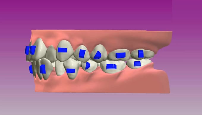 make clear aligner with 3shape