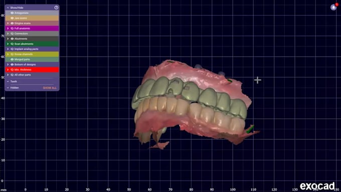 design full arch all on x prosthesis