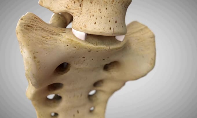 create 3d orthopedic surgery animation, knee replacement medical explainer video