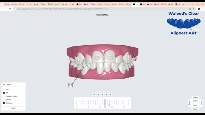 design orthodontic planning for clear aligner treatments