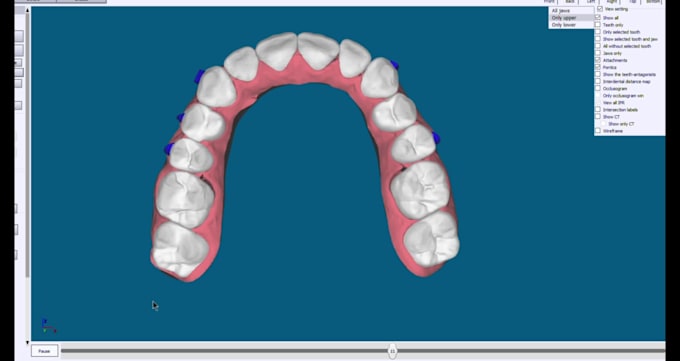 do dental clear aligner treatment planning on onyxceph, hit and 3shape analyzer