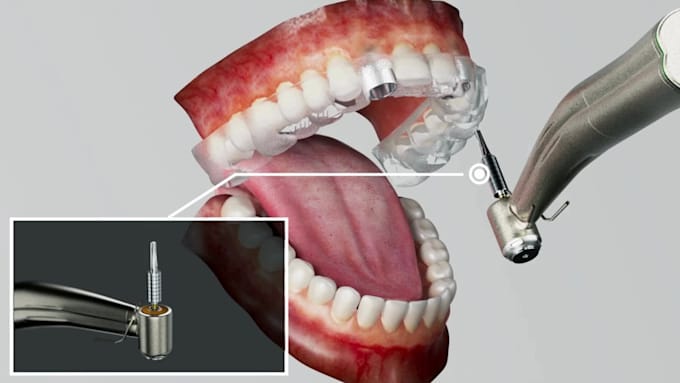 create 3d dental implant animation orthodontic explainer and dental device video