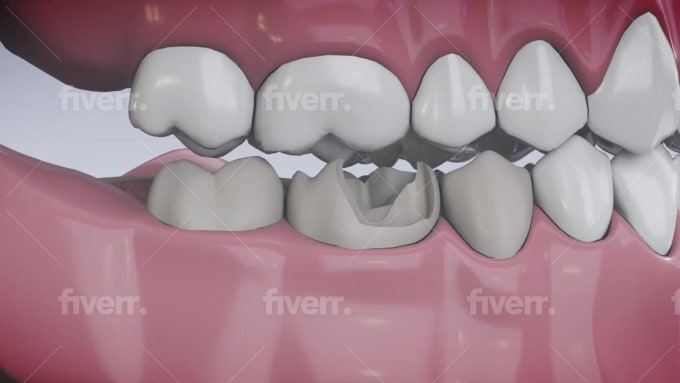 Do 3d animation dental surgery videos at the best price by Majidkhan534 | Fiverr Do 3d animation dental surgery videos at the best price by Majidkhan534 | Fiverr