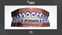do aligners treatment planning using 3shape orthosystem
