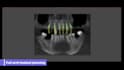 design implant surgical guide and stackable guide in realguide
