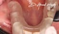 do implant planning, surgical guides, and stackable guides
