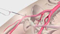 create 3d medical animation, medical video, surgery