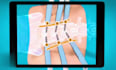 do 3d medical device animation 3d surgical device animation 3d medical explainer