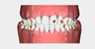 design clear aligner treatment plans