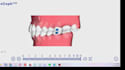 create orthodontist verified 3d clear aligner treatment planning and stl setups