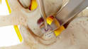 create 3d spinal implant animation orthopaedic medical visualization