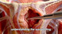 create 3d ai medical animation, ai surgery animation, ai explainer pharma video