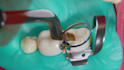 create dental implant animation caries removal and dental device explainer video