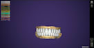 design custom abutments and full arch implant restorations