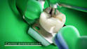 medical animation anatomy surgery biomedical animation medical oral implants vid