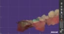 create accurate crowns and bridges using exocad