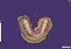 expert dental design on exocad crowns, bridge and more