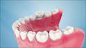 create realistic 3d dental implant and dental procedure animations