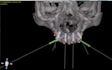 plan and design surgical guide