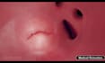create realistic 3d medical animation medical device surgery explainer video