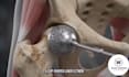 create 3d orthopedic implant, spine and joint surgery animation
