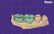 design professional dental crowns, bridges