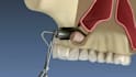 create realistic 3d dental implant animation and dental surgery animation