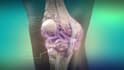 3d medical device explainer, anatomy video and medical animation